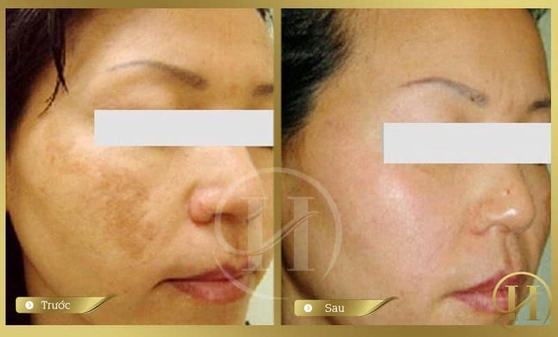 Trị nám bằng Laser Spectra Toning