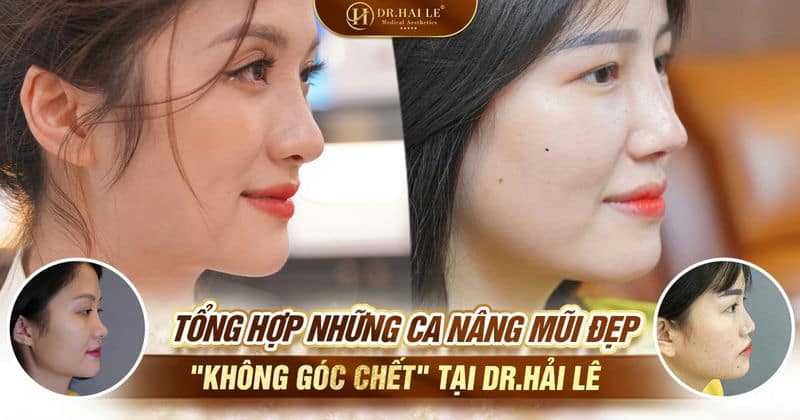 Tổng hợp những ca nâng mũi đẹp "không góc chết" tại Dr.Hải Lê