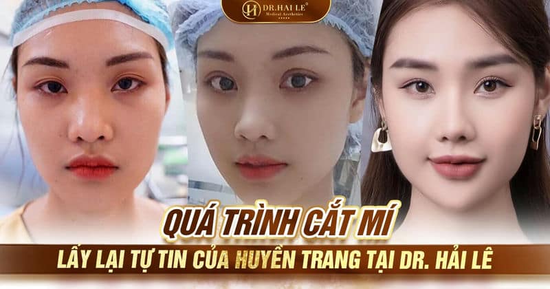 Quá trình cắt mí - lấy lại tự tin của Huyền Trang tại Dr. Hải Lê