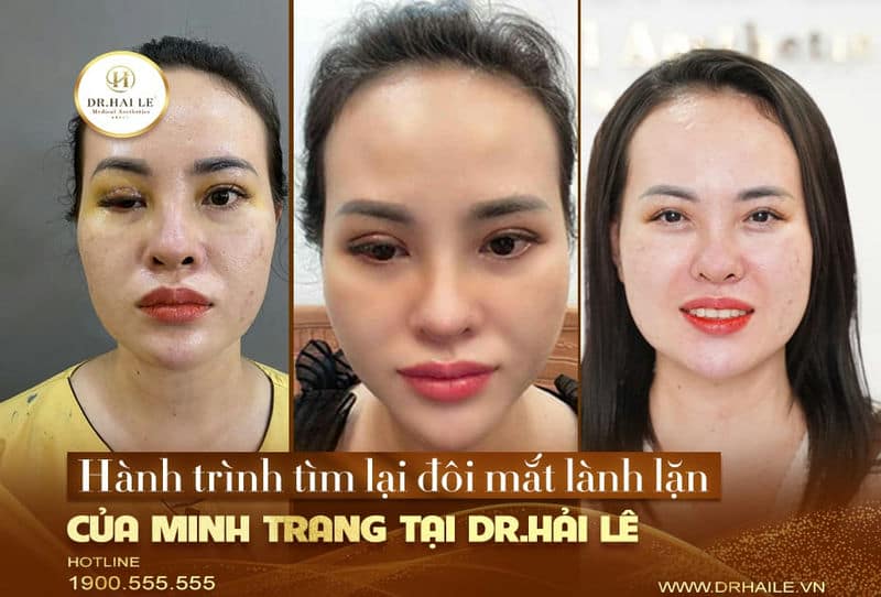 Hành trình tìm lại đôi mắt lành lặn của Minh Trang tại Dr.Hải Lê