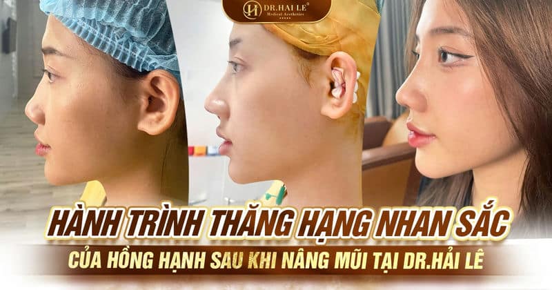 Hành trình thăng hạng nhan sắc của Hồng Hạnh sau khi nâng mũi tại Dr.Hải Lê