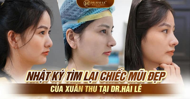 Nhật ký tìm lại chiếc mũi đẹp của Xuân Thu tại Dr.Hải Lê
