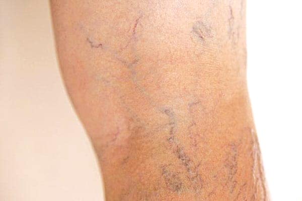 Hiện tượng giãn mao mạch ở chân