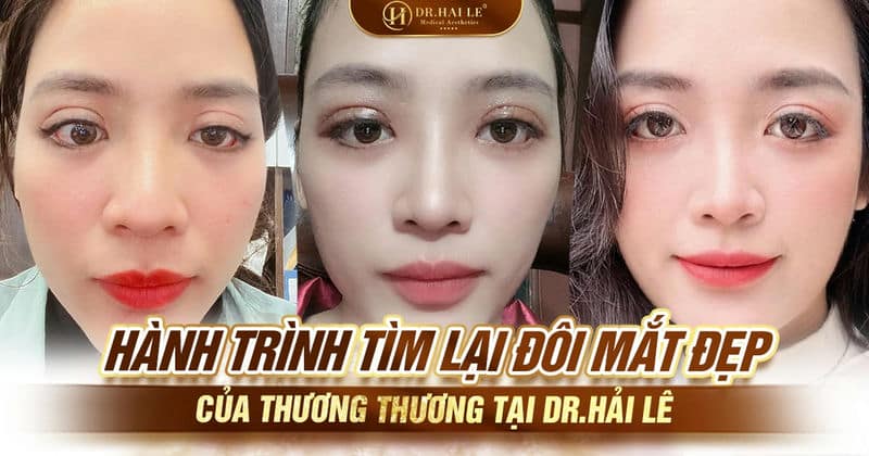 Hành trình tìm lại đôi mắt đẹp của Thương Thương tại Dr.Hải Lê