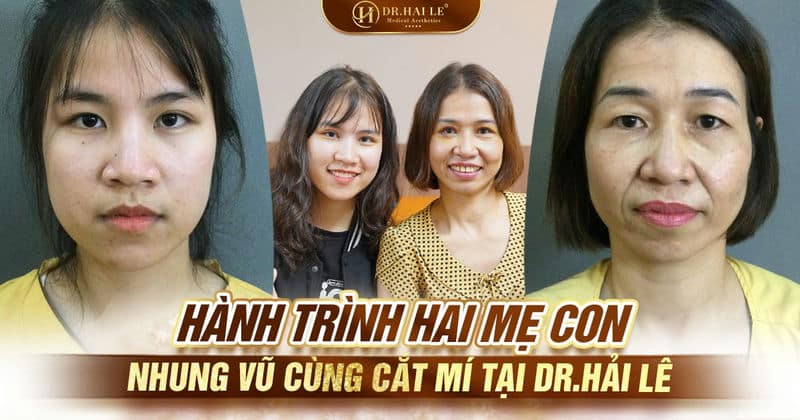 Hành trình hai mẹ con Nhung Vũ cùng cắt mí tại Dr.Hải Lê Hành trình hai mẹ con Nhung Vũ cùng cắt mí tại Dr.Hải Lê