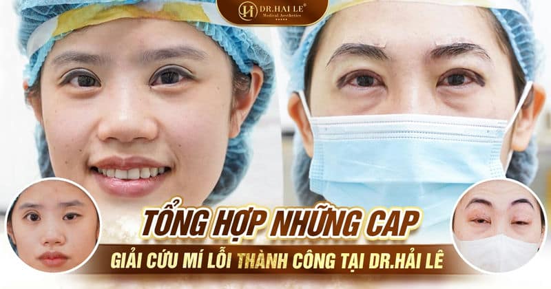 Tổng hợp những ca giải cứu mí lỗi thành công tại Dr.Hải Lê
