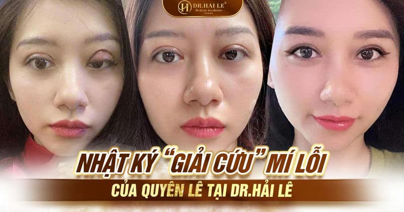 Nhật ký “giải cứu” mí lỗi của Quyên Lê tại Dr.Hải Lê