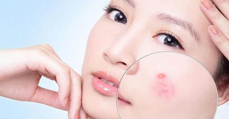 Những cách chăm sóc da mụn không thể bỏ qua