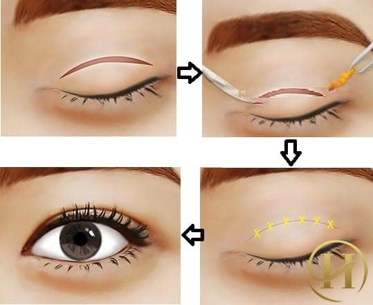 Nhấn mí chữa sụp mí mắt