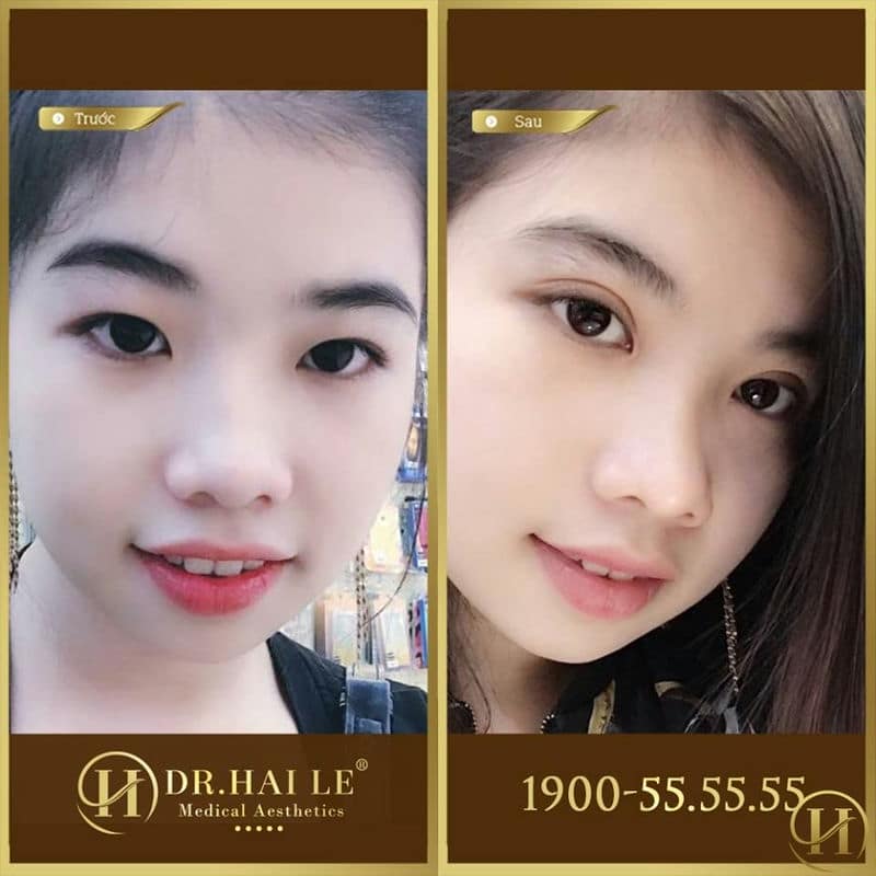 Bạn gái thực hiện cắt mí Mani Mini Deep 5D chữa mắt xếch