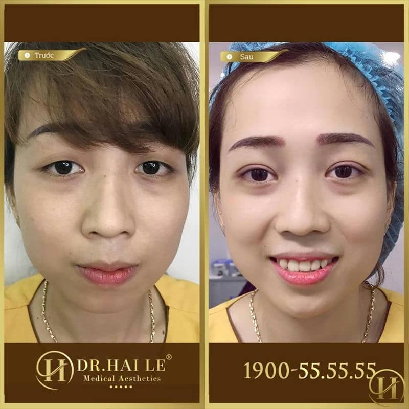 So sánh kết quả trước sau cắt mí Mani Mini Deep 5D tại Dr.Hải Lê
