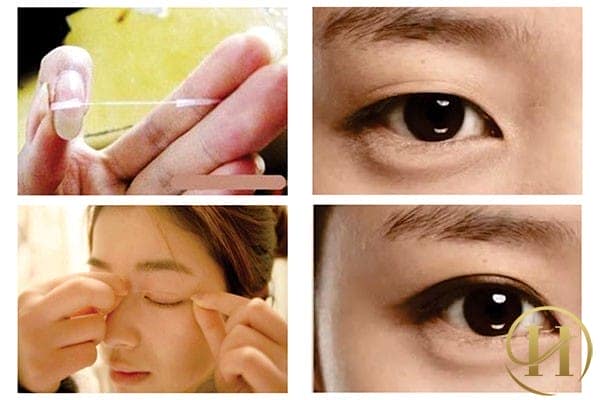 Hướng dẫn sử dụng chỉ kích mí