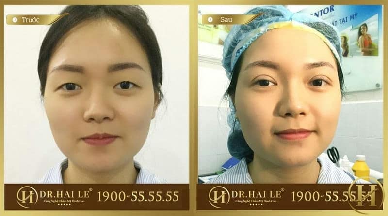 Kết quả nhấn mí tại Dr.Hải Lê