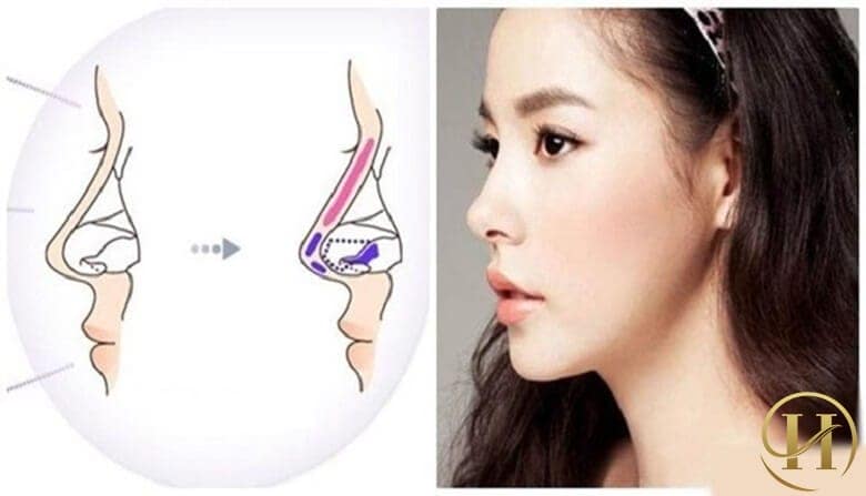 Nâng mũi L Line 2 lớp tại Dr.Hải Lê