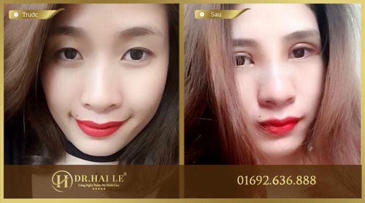 Kết quả nhấn mí Thái Lan tại Dr,Hải Lê