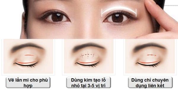 Quy trình nhấn mí luôn chỉ an toàn 