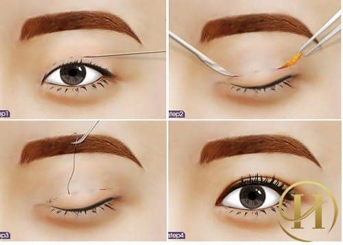 Quy trình nhấn mí không phẫu thuật