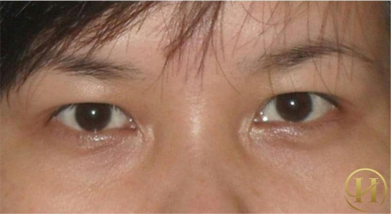 Sụp mí mắt do bệnh lý 