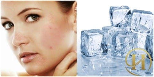 Chườm đá lạnh - cách chữa dị ứng mỹ phẩm nhanh chóng