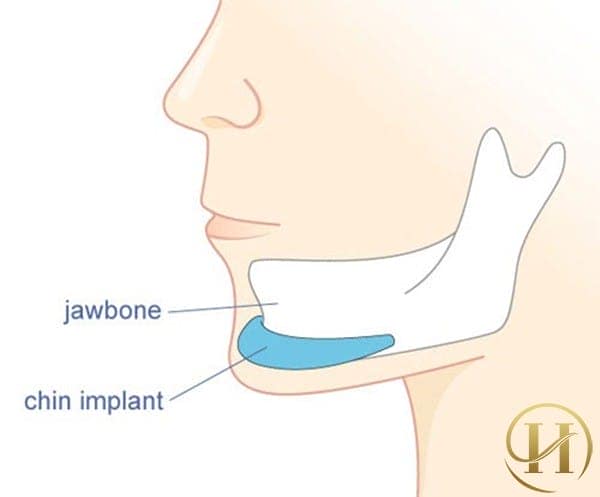 Hình ảnh mô tả vị trí độn cằm với người có cằm ngắn