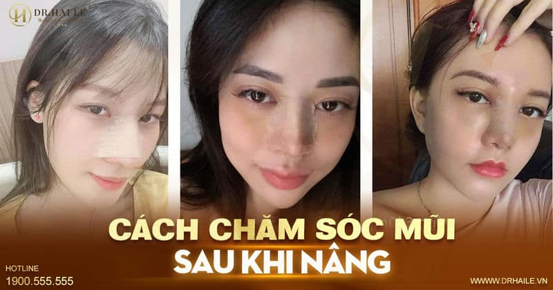 Cách chăm sóc mũi sau khi nâng