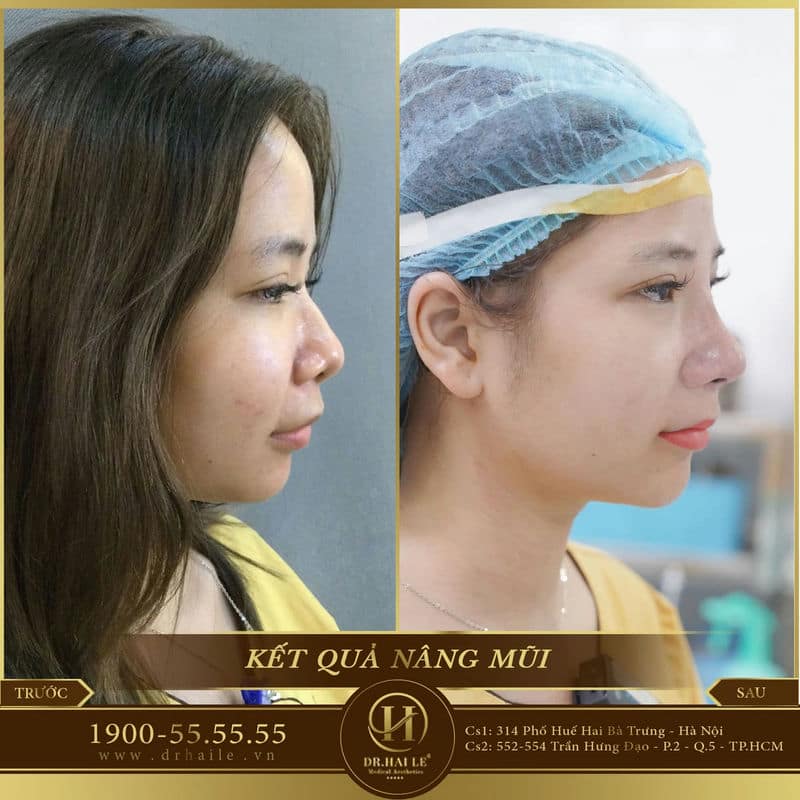 Làm Mũi Đẹp Dr.Hải Lê
