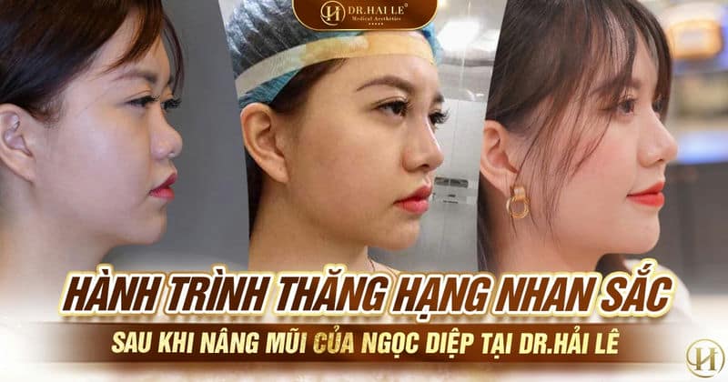 Hành trình thăng hạng nhan sắc của Ngọc Diệp sau khi nâng mũi tại Dr.Hải Lê