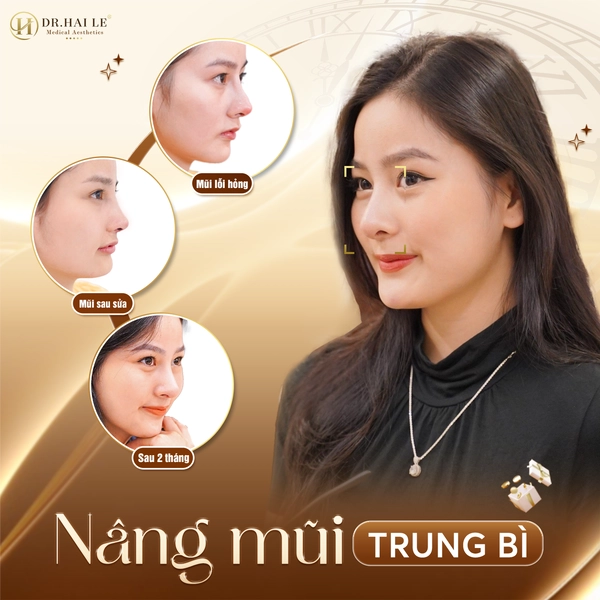 Nâng Mũi Trung Bì