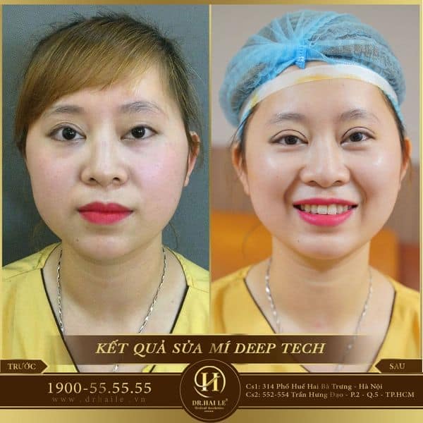 Sửa mí dưới Deep Tech Repair