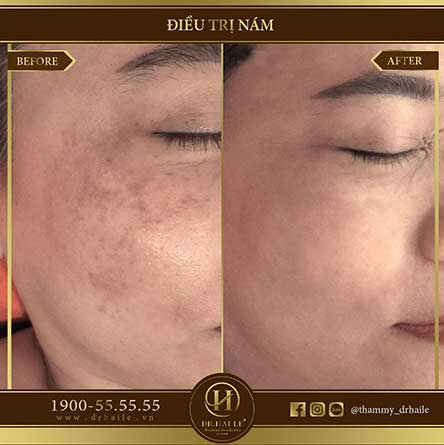 Công nghệ trị nám