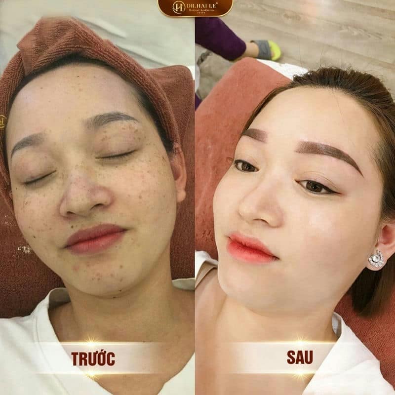 Ảnh trước sau  