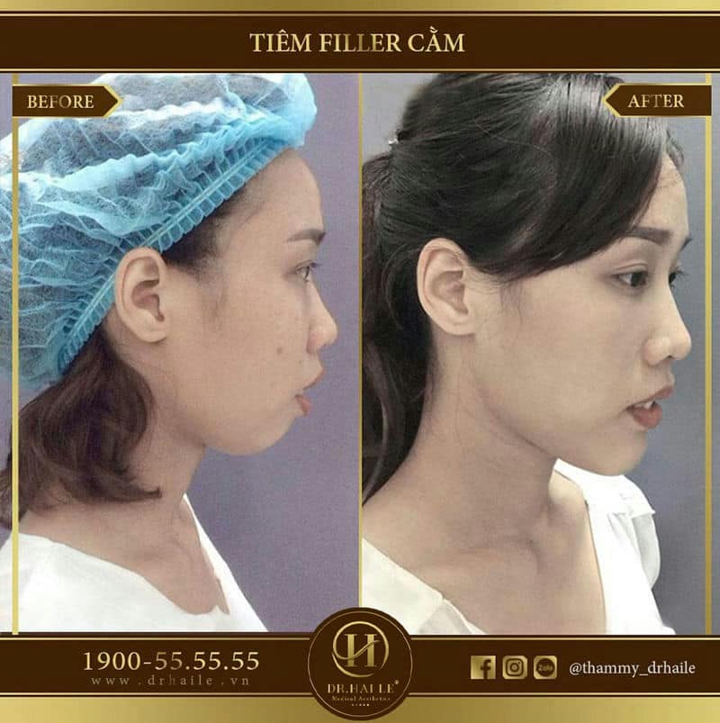 Độn cằm bằng Filler
