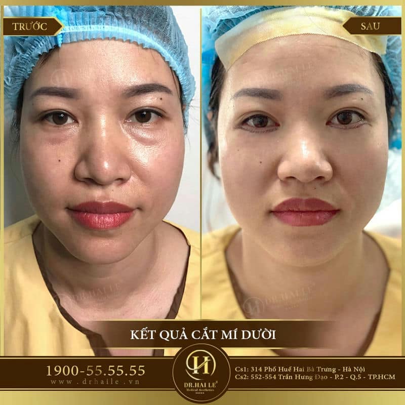 Sửa mí dưới Deep Tech Repair