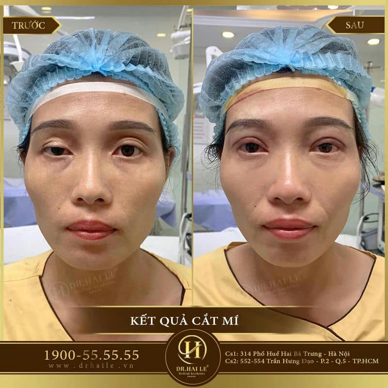 Cắt mí Mani Mini Deep 5D