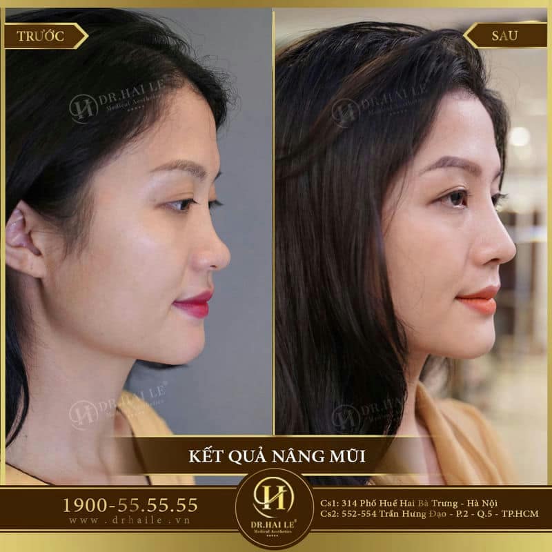 Nâng mũi Medi-Form