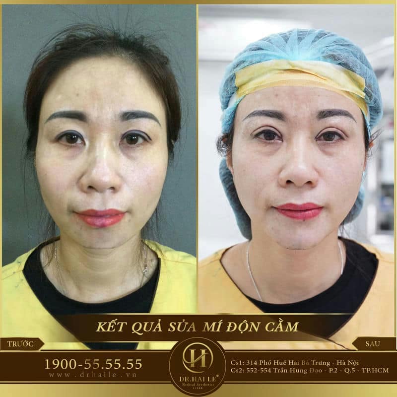 Phẫu thuật thẫm mỹ độn cằm