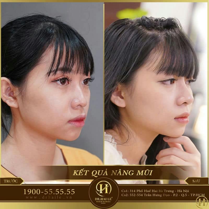 Nâng mũi Demi Tech 6D