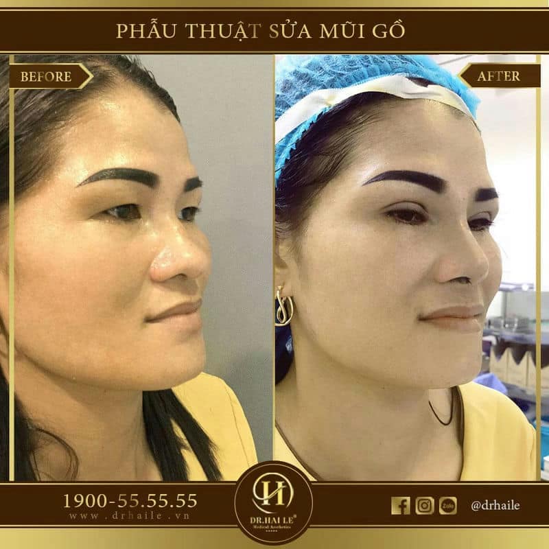Phẫu thuật sửa mũi gồ
