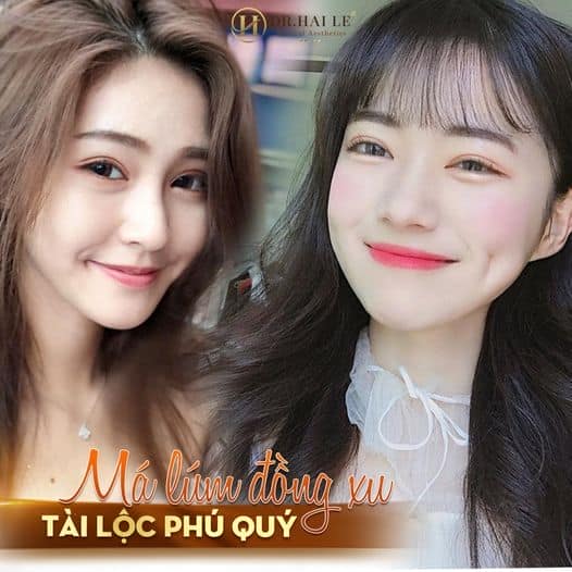 Tạo má lúm đồng tiền