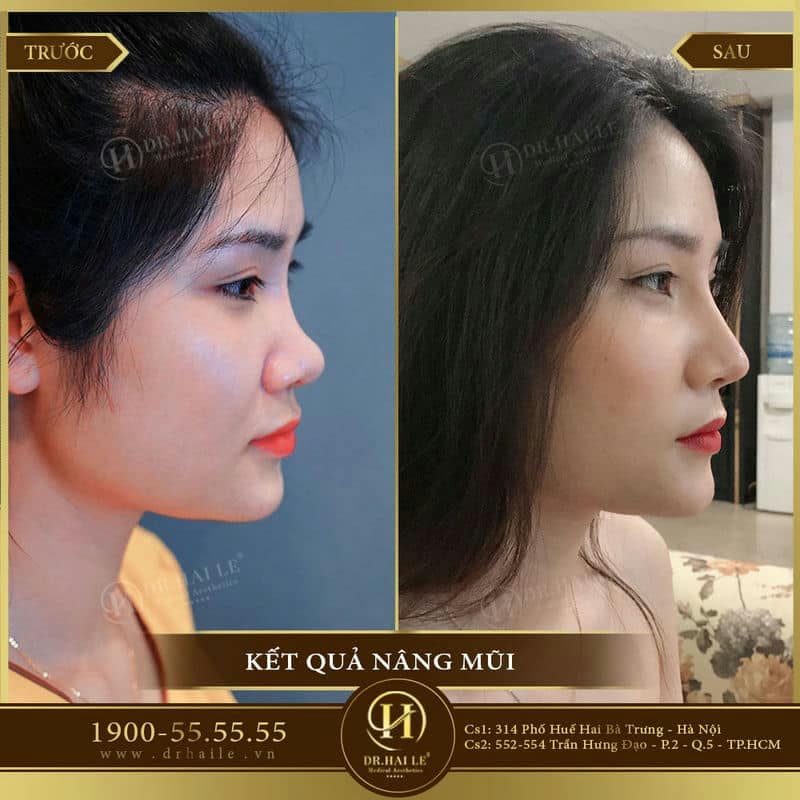 Nâng mũi Medi-Form