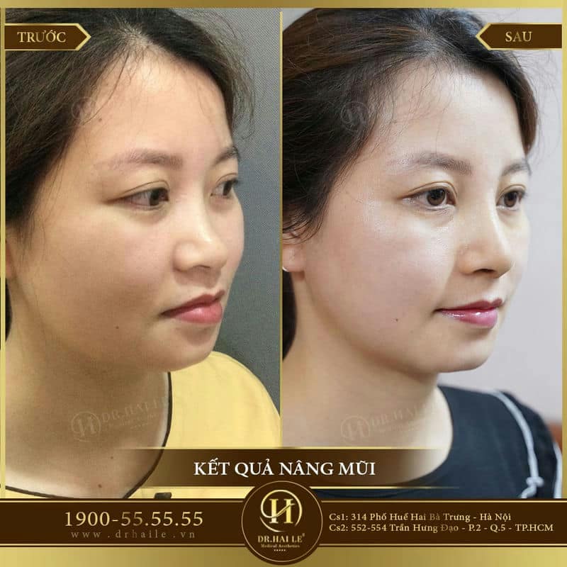 Nâng mũi Demi Tech 6D