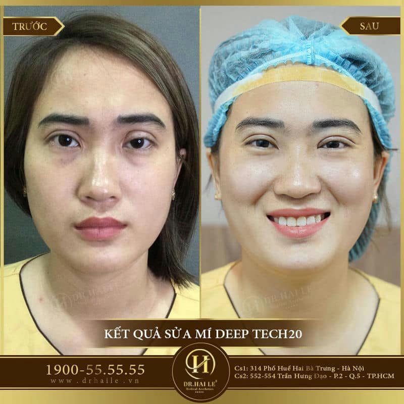 Sửa Mí Lỗi Hỏng Deep Tech20