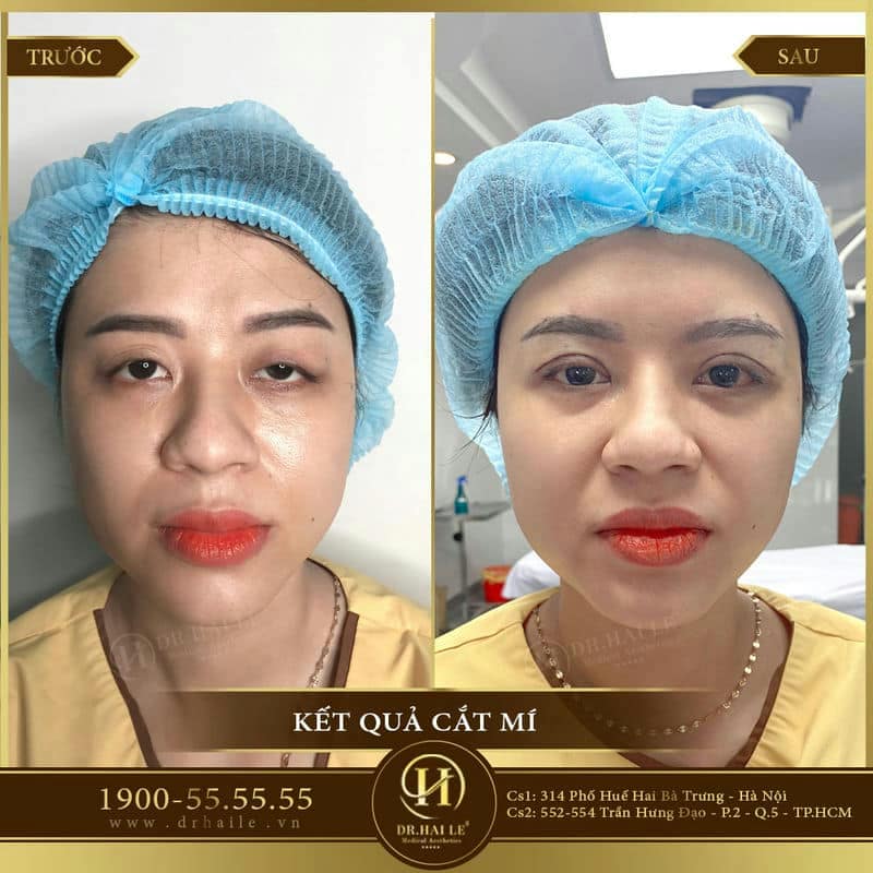 Cắt mí Mani Mini Deep 5D