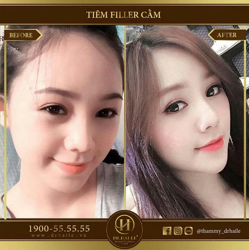 Độn cằm bằng Filler