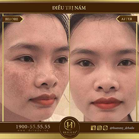 Công nghệ trị nám