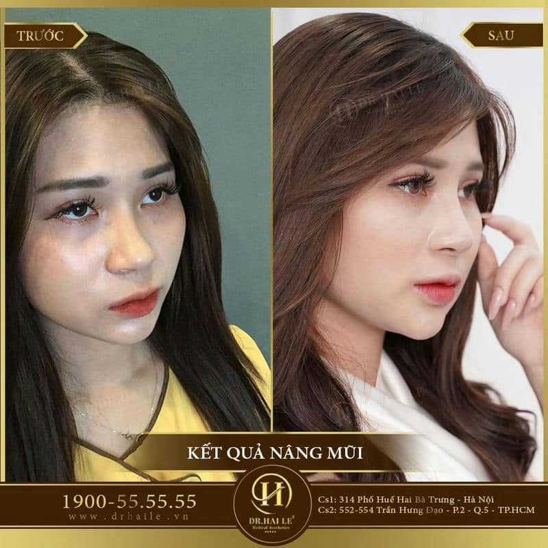 Nâng mũi Demi 5D