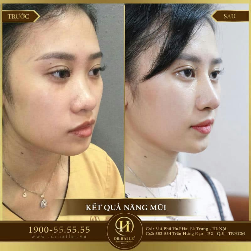Nâng mũi L Line