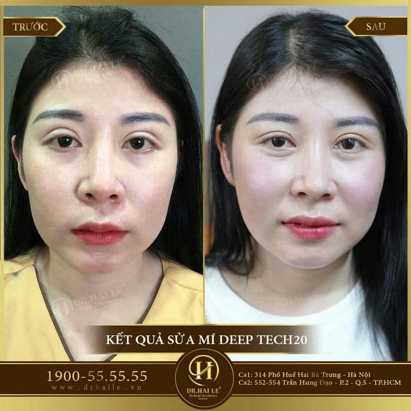 Sửa Mí Lỗi Hỏng Deep Tech20