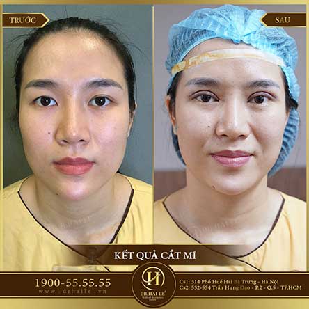 Cắt mí Mani Open Deep 5D