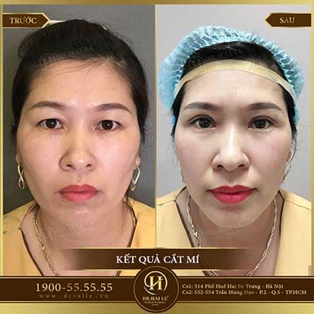 Cắt mí Mani Open Deep 5D